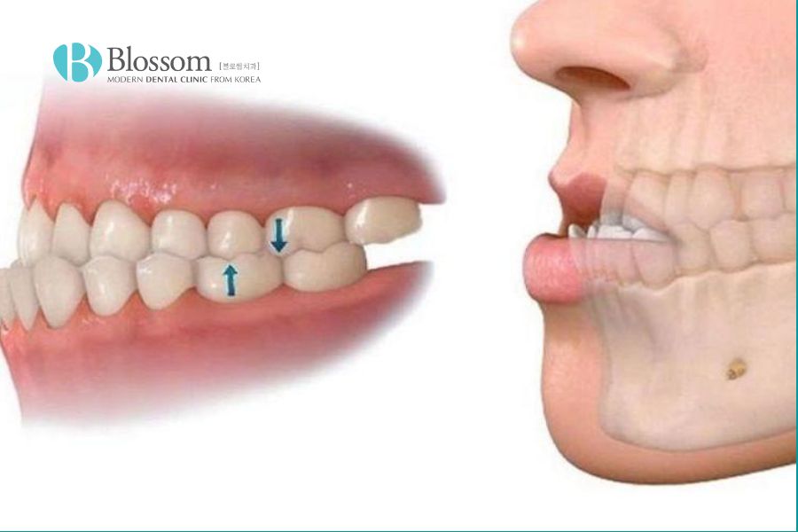 Răng vẩu là gì? Các loại răng vẩu thường gặp 8 rang vau la gi 7