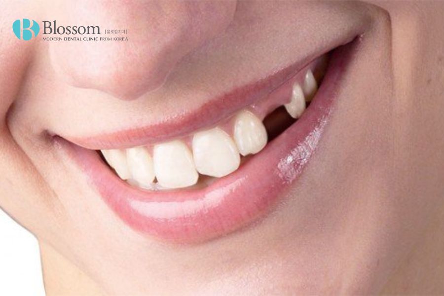 Tại sao phải cấy ghép Implant? 2 tai sao phai cay ghep implant 1