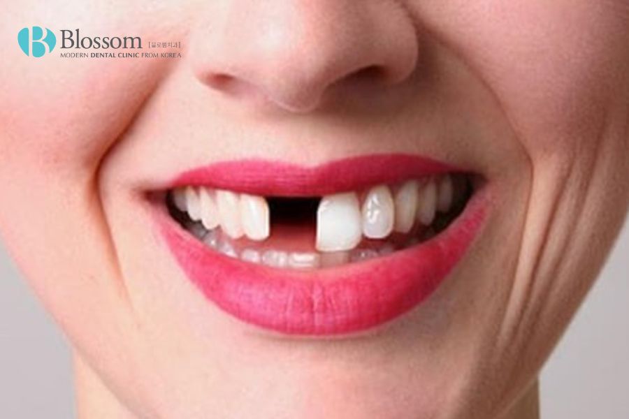 Tại sao phải cấy ghép Implant? 3 tai sao phai cay ghep implant 2