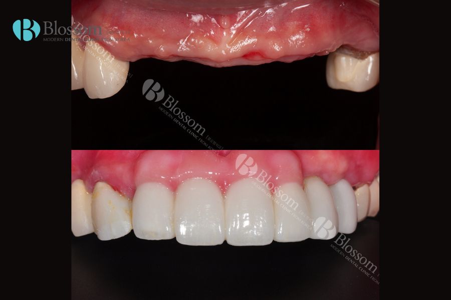 Tại sao phải cấy ghép Implant? 8 tai sao phai cay ghep implant 7