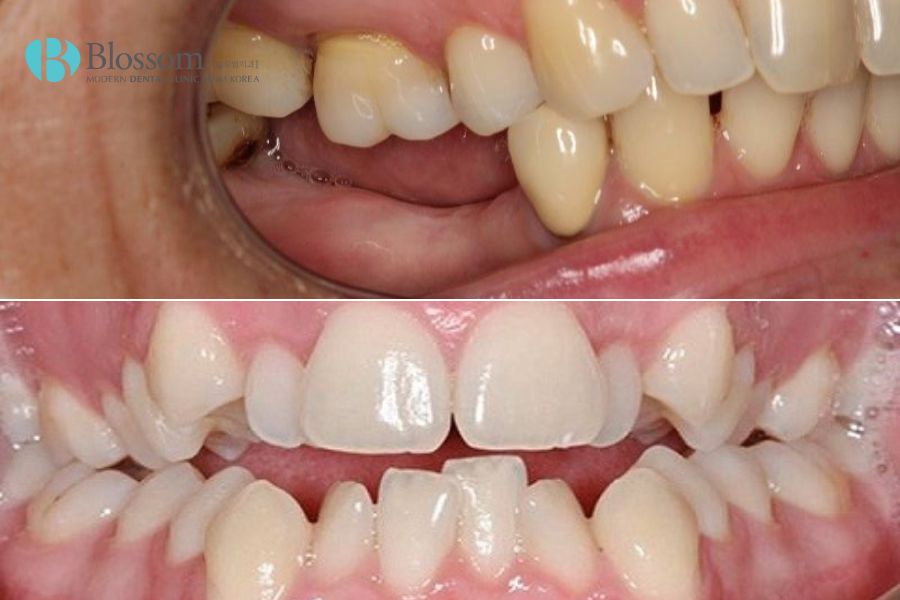 Trồng răng cho người lớn tuổi: Phương pháp nào tốt? 2 trong rang cho nguoi lon tuoi 1
