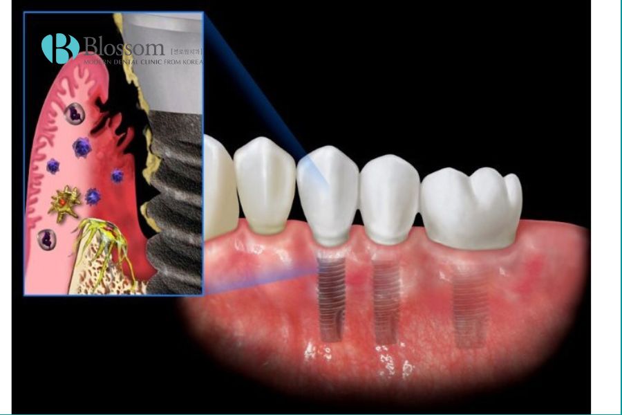 Trồng răng Implant có nguy hiểm không? Các biến chứng thường gặp. 3 trong rang co nguy hiem khong 3