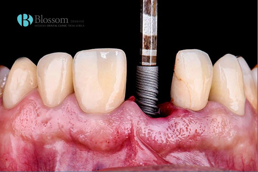 Trồng răng Implant có nguy hiểm không? Các biến chứng thường gặp. 4 trong rang co nguy hiem khong 4