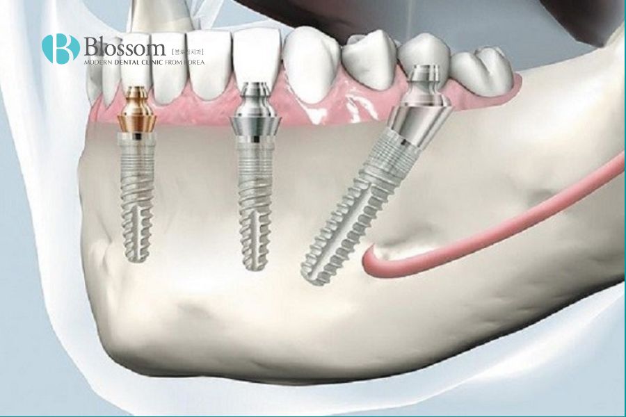 Trồng răng Implant có nguy hiểm không? Các biến chứng thường gặp. 5 trong rang co nguy hiem khong 6