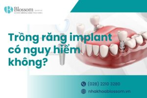Trồng răng Implant có nguy hiểm không? Các biến chứng thường gặp.