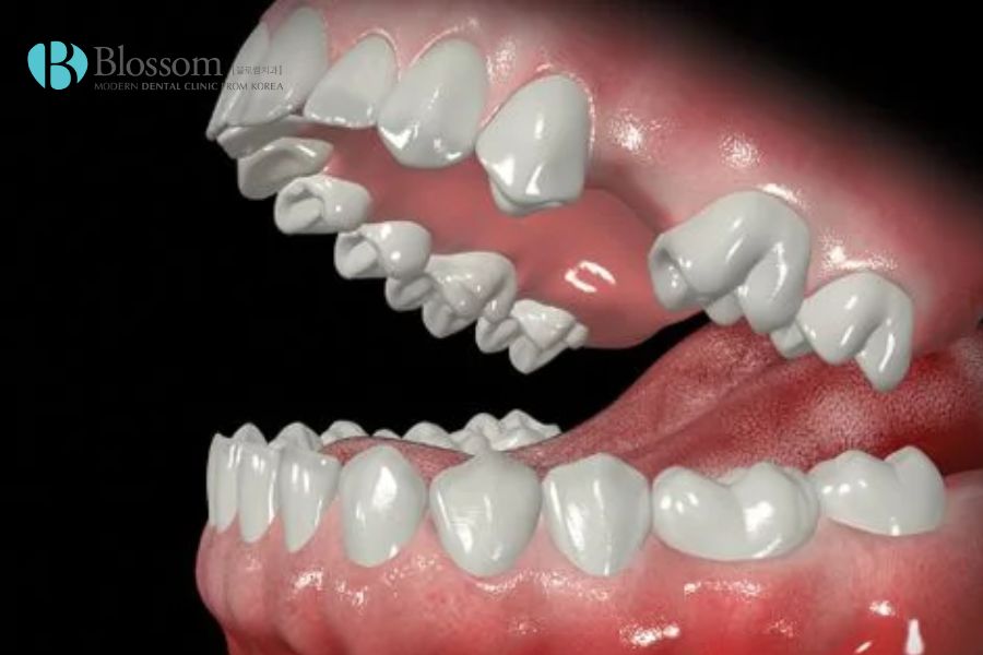Trồng răng giả cố định có đau không? - Nha Khoa Blossom 2 trong rang gia co dinh co dau khong 1