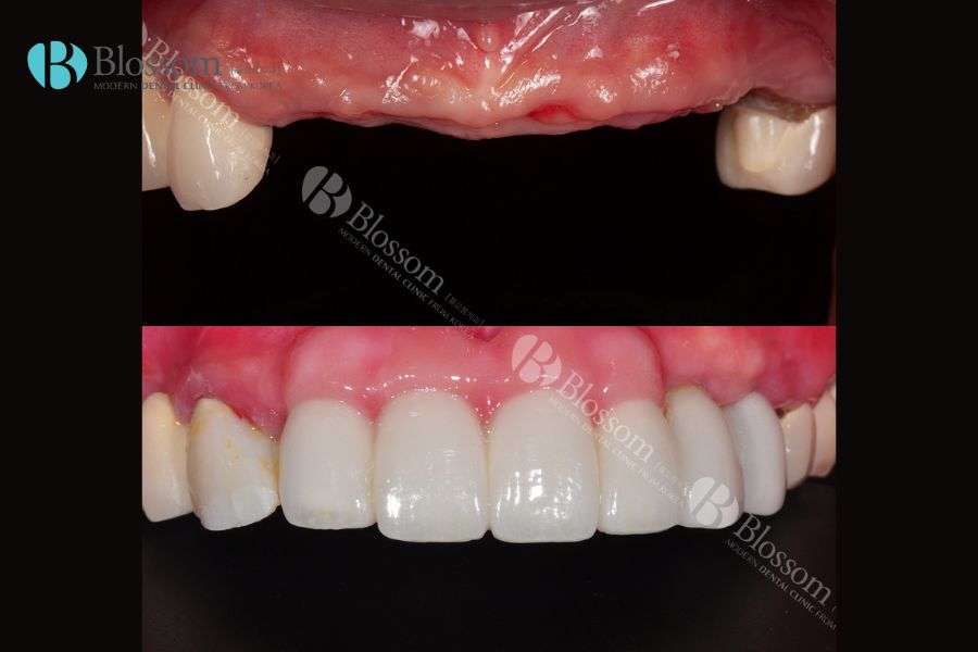 Trồng răng giả cố định có đau không? - Nha Khoa Blossom 10 trong rang gia co dinh co dau khong 10