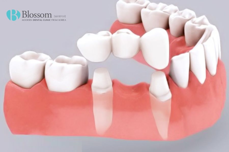 Trồng răng giả cố định có đau không? - Nha Khoa Blossom 3 trong rang gia co dinh co dau khong 2