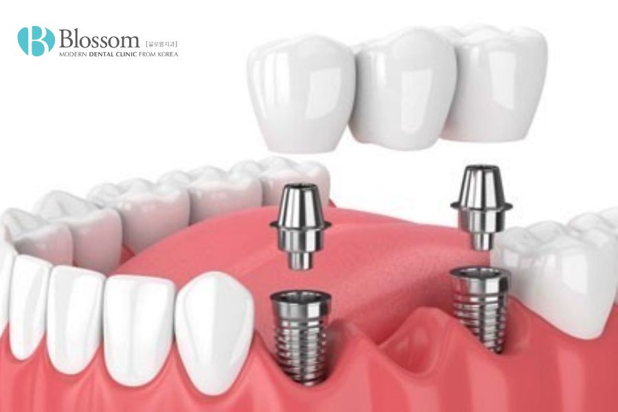 Trồng răng giả cố định có đau không? - Nha Khoa Blossom 5 trong rang gia co dinh co dau khong 4