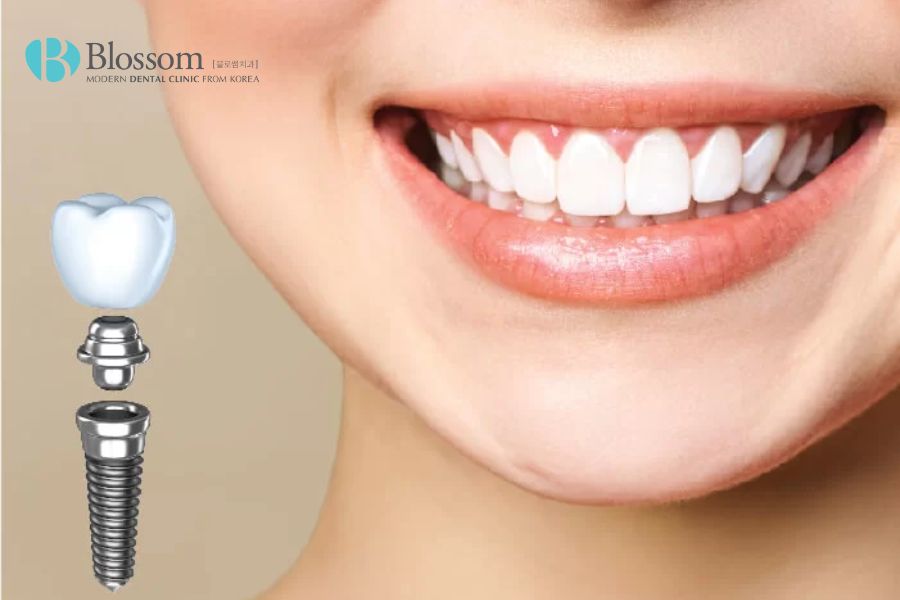 Trồng răng giả cố định có đau không? - Nha Khoa Blossom 6 trong rang gia co dinh co dau khong 5