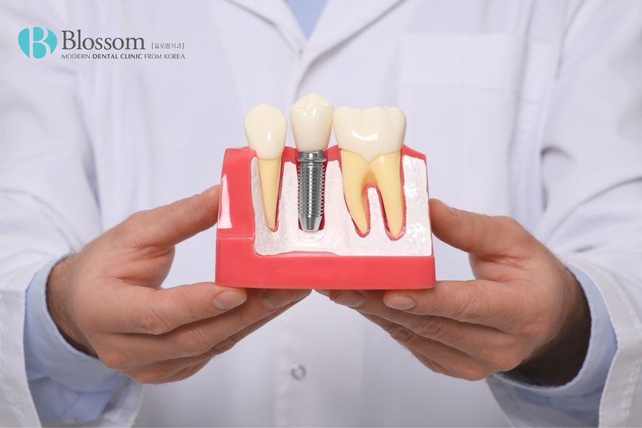 Trồng răng giả cố định có đau không? - Nha Khoa Blossom 7 trong rang gia co dinh co dau khong 6