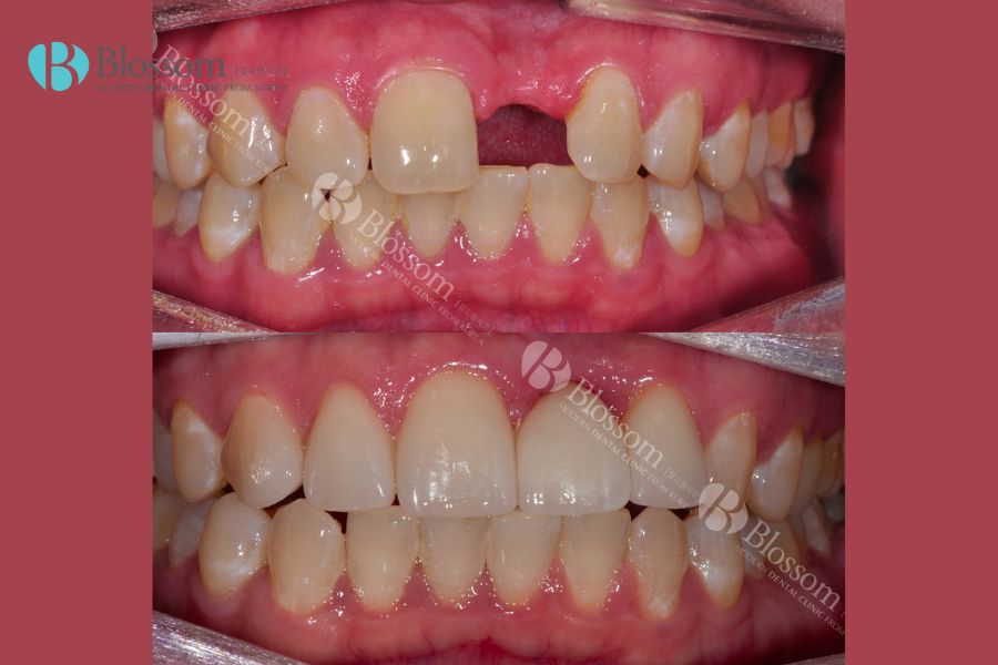 Trồng răng giả cố định có đau không? - Nha Khoa Blossom 8 trong rang gia co dinh co dau khong 8