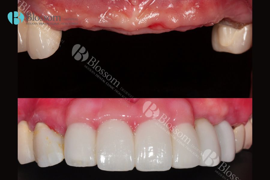 Trồng răng giả tháo lắp giá bao nhiêu? - Nha Khoa Blossom 4 trong rang gia thao lap gia bao nhieu 4