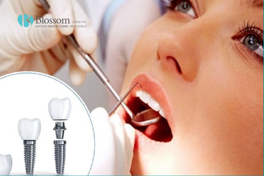 Trồng răng implant có đau không? Yếu tố ảnh hưởng trồng Implant? 2 trong rang implant co dau khong 1