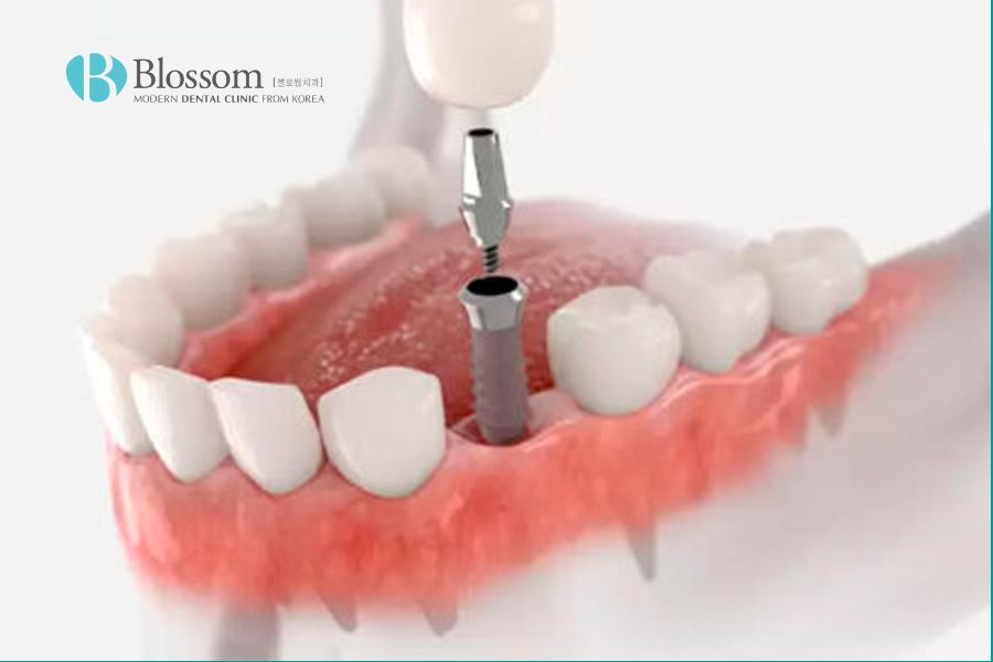 Trồng răng implant có đau không? Yếu tố ảnh hưởng trồng Implant? 12 trong rang implant co dau khong 11