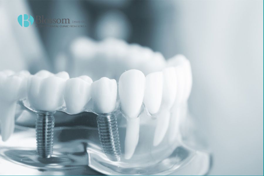 Trồng răng implant có đau không? Yếu tố ảnh hưởng trồng Implant? 5 trong rang implant co dau khong 4