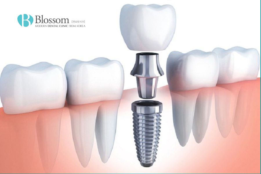 Trồng răng implant có đau không? Yếu tố ảnh hưởng trồng Implant? 6 trong rang implant co dau khong 5