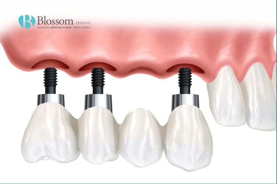 Trồng răng implant có đau không? Yếu tố ảnh hưởng trồng Implant? 7 trong rang implant co dau khong 6