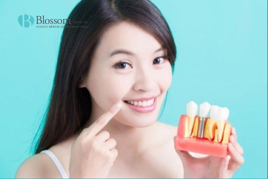 Tuổi thọ răng implant kéo dài được bao lâu? 2 tuoi tho rang implant 1