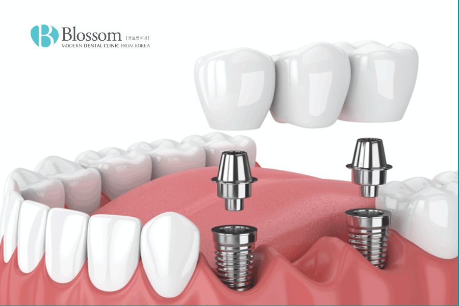 Tuổi thọ răng implant kéo dài được bao lâu? 4 tuoi tho rang implant 3