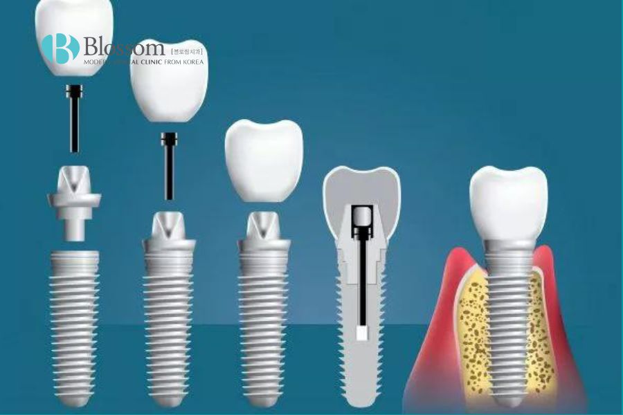 Tuổi thọ răng implant kéo dài được bao lâu? 5 tuoi tho rang implant 4