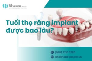 Tuổi thọ răng implant kéo dài được bao lâu?