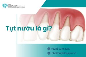 Tụt nướu, nguyên nhân và cách điều trị hiệu quả.