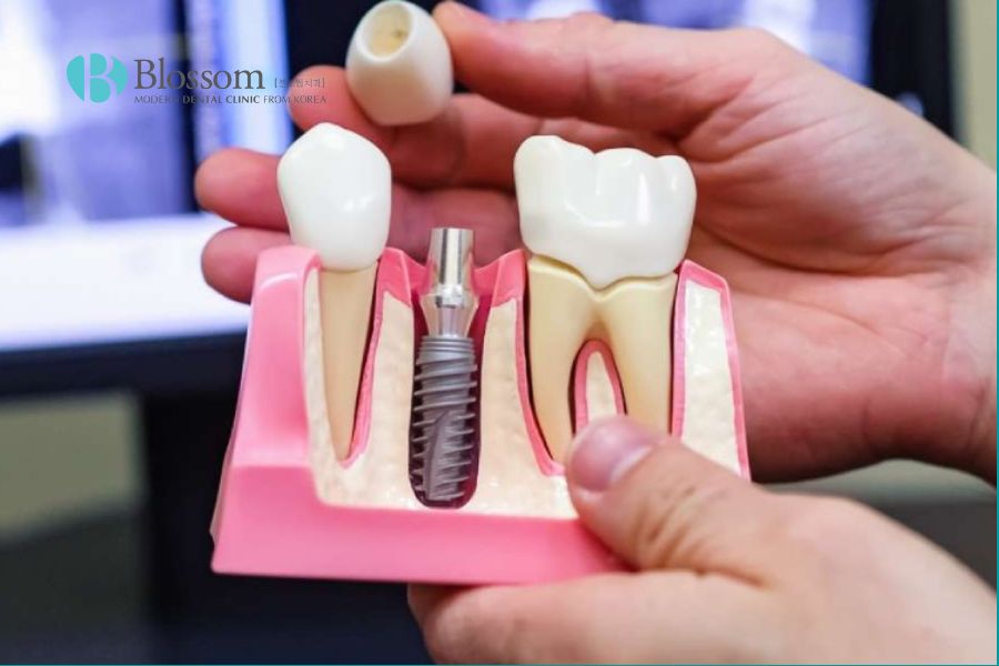 Ưu nhược điểm khi trồng răng implant như thế nào? 3 uu nhuoc diem khi trong rang implant 2