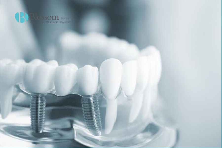 Ưu nhược điểm khi trồng răng implant như thế nào? 4 uu nhuoc diem khi trong rang implant 3