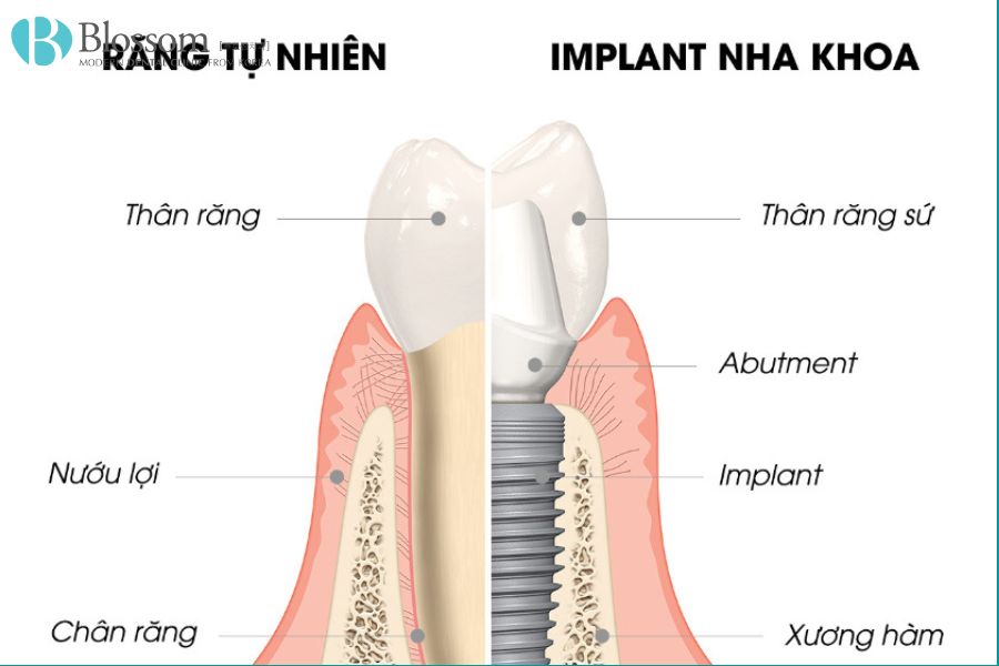 Ưu nhược điểm khi trồng răng implant như thế nào? 6 uu nhuoc diem khi trong rang implant 5