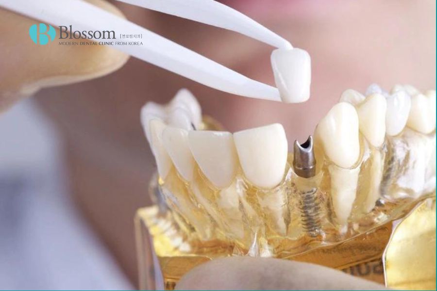 Ưu nhược điểm khi trồng răng implant như thế nào? 8 uu nhuoc diem khi trong rang implant 7