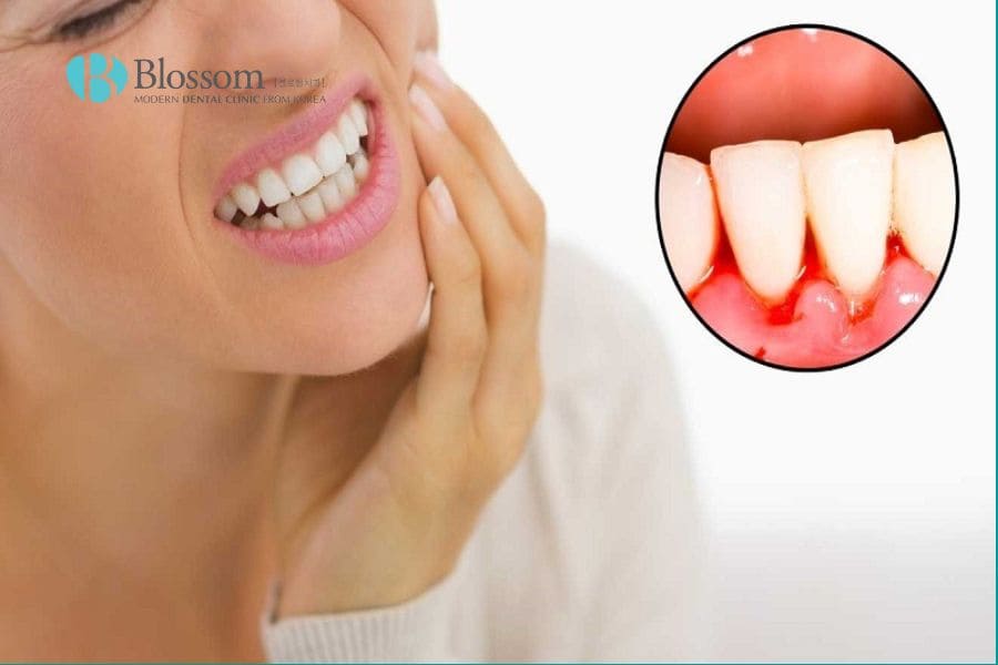 Vì sao bị đau nướu răng? Nguyên nhân gây đau nướu răng. 2 vi sao bi dau nuou rang 1