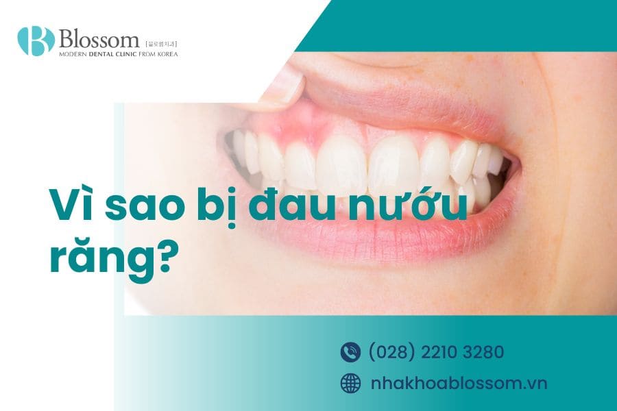 Vì sao bị đau nướu răng? Nguyên nhân gây đau nướu răng.