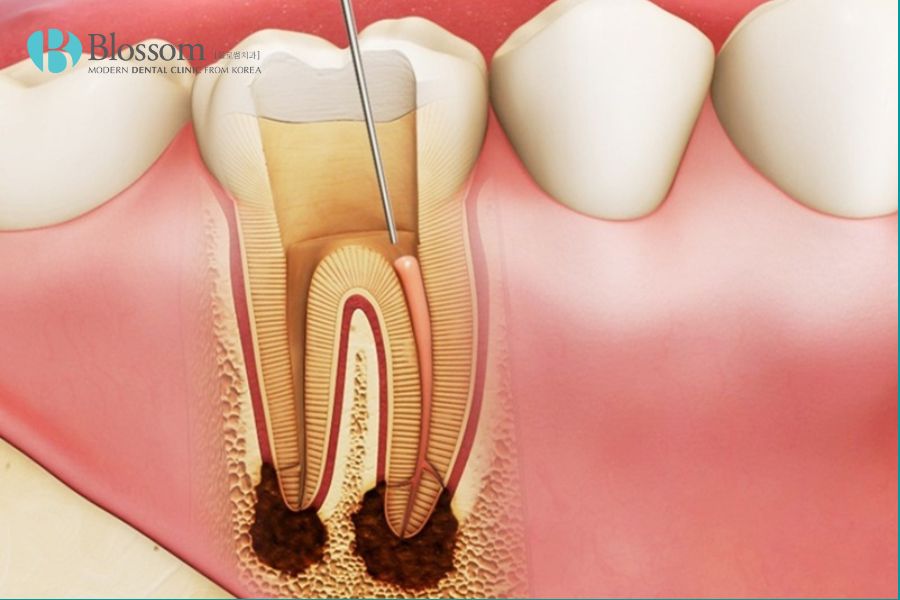 Viêm tủy răng là gì? Các biện pháp điều trị viêm tủy 3 viem tuy rang la gi 4