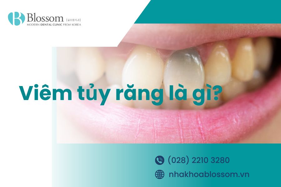 Viêm tủy răng là gì? Các biện pháp điều trị viêm tủy