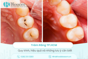 Trám Răng Là Gì? – Quy trình, hiệu quả và những lưu ý cần biết