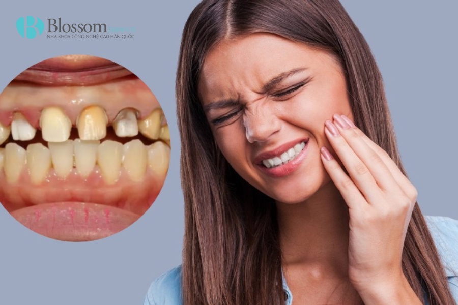 Bọc răng sứ giá rẻ – Giải pháp thẩm mỹ tiết kiệm hay “cái bẫy” đắt giá? 3 boc rang su gia re 2
