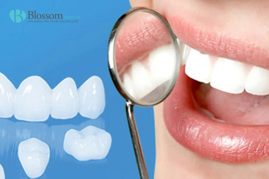 Bọc răng sứ giá rẻ – Giải pháp thẩm mỹ tiết kiệm hay “cái bẫy” đắt giá? 5 boc rang su gia re 4