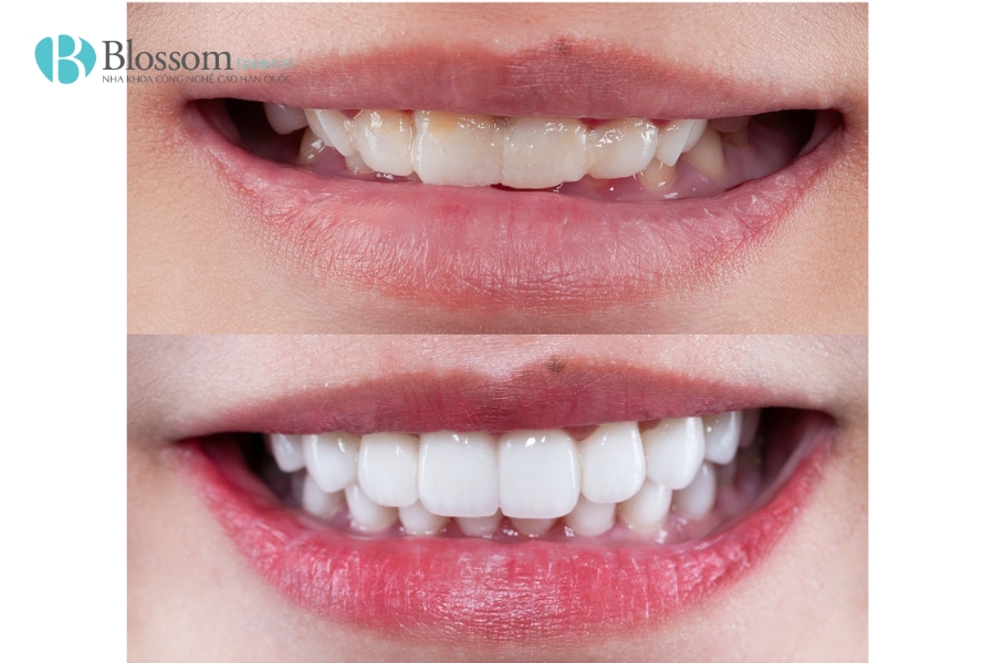 Bọc răng sứ giá rẻ – Giải pháp thẩm mỹ tiết kiệm hay “cái bẫy” đắt giá? 6 boc rang su gia re 5