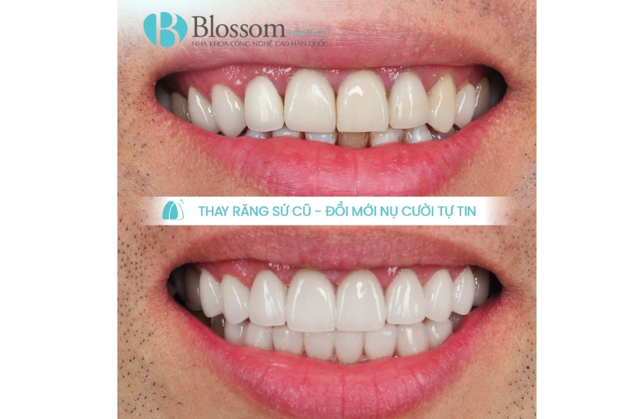 Bọc răng sứ giá rẻ – Giải pháp thẩm mỹ tiết kiệm hay “cái bẫy” đắt giá? 8 boc rang su gia re 6