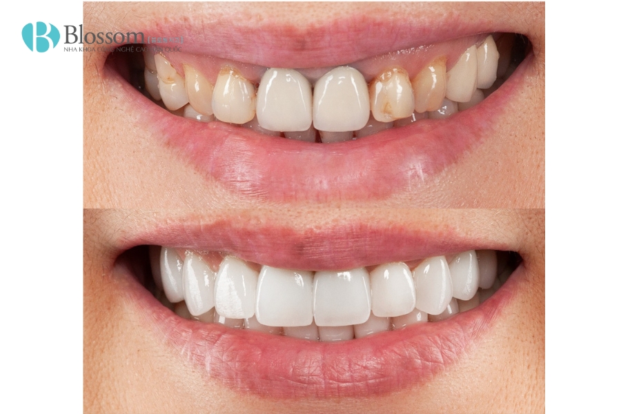 Bọc răng sứ giá rẻ – Giải pháp thẩm mỹ tiết kiệm hay “cái bẫy” đắt giá? 7 boc rang su gia re 7