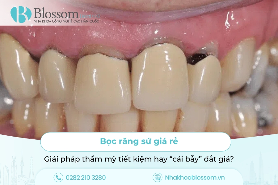 Bọc răng sứ giá rẻ – Giải pháp thẩm mỹ tiết kiệm hay “cái bẫy” đắt giá?