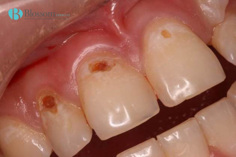 Chân răng bị đen là dấu hiệu cảnh báo gì? Nguyên nhân & cách xử lý an toàn tại nhà 2 chan rang bi den 2