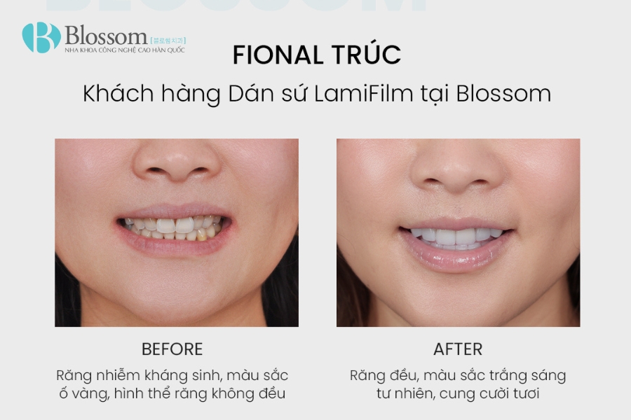 Chân răng bị đen là dấu hiệu cảnh báo gì? Nguyên nhân & cách xử lý an toàn tại nhà 3 chan rang bi den 3