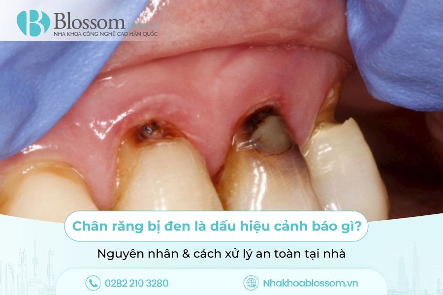 Chân răng bị đen là dấu hiệu cảnh báo gì? Nguyên nhân & cách xử lý an toàn tại nhà