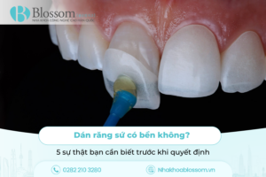 Dán răng sứ có bền không? 5 sự thật bạn cần biết trước khi quyết định