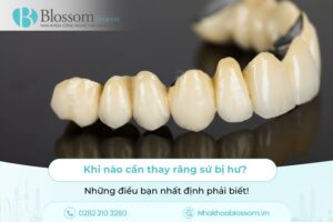 Khi nào cần thay răng sứ bị hư? Những điều bạn nhất định phải biết!