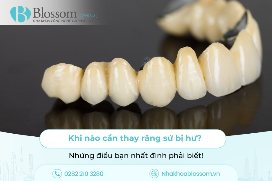 Khi nào cần thay răng sứ bị hư? Những điều bạn nhất định phải biết!
