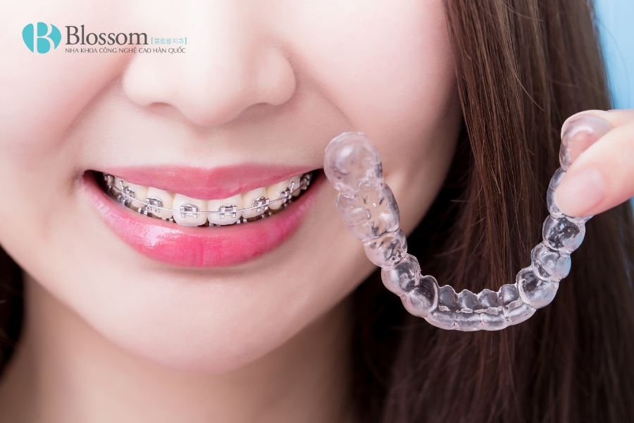 Niềng răng có được vĩnh viễn không? Giải đáp từ chuyên gia nha khoa 2 nieng rang co duoc vinh vien khong 1