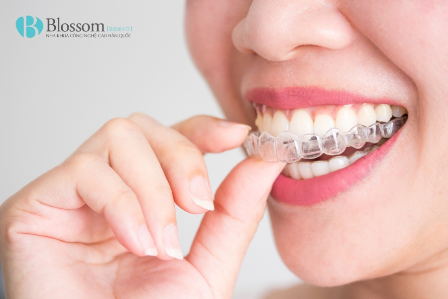 Niềng răng có được vĩnh viễn không? Giải đáp từ chuyên gia nha khoa 3 nieng rang co duoc vinh vien khong 2